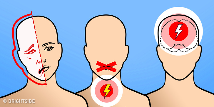 Stroke สาเหตุโรคหลอดเลือดสมอง สโตร๊ก เส้นเลือดในสมอง โรคหลอดเลือดสมอง โรคเส้นเลือดในสมอง โรคเส้นเลือดในสมองตีบ